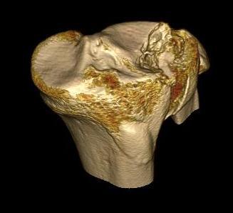 Tibial Plateau Joint Depression